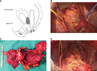 Rectosigmoid sparing en bloc pelvic resection for fixed ovarian tumors: Surgical technique and perioperative and oncologic outcomes